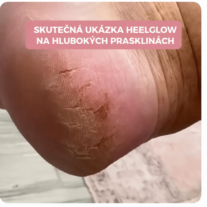 Ukázka suché popraskané paty